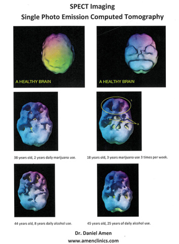 These images of brain scans were provided by Dr. Daniel Amen with the Amen Clinics organization and show the deterioration from years of drug and alcohol abuse